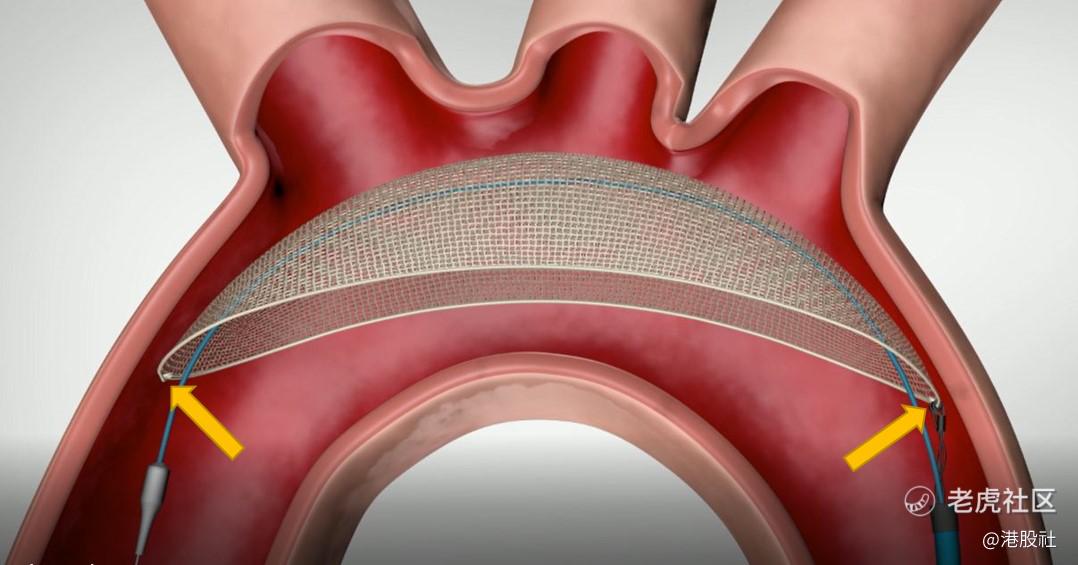 启明医疗旗下创新器械TriGUARD 3(TM)达成主要安全终点