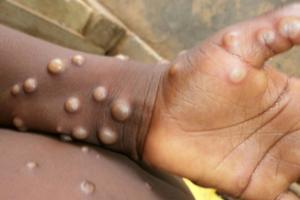 恐怖猴痘扩散14国！密切接触“人传人”模式爆发 美国CDC：天花疫苗防护力85%