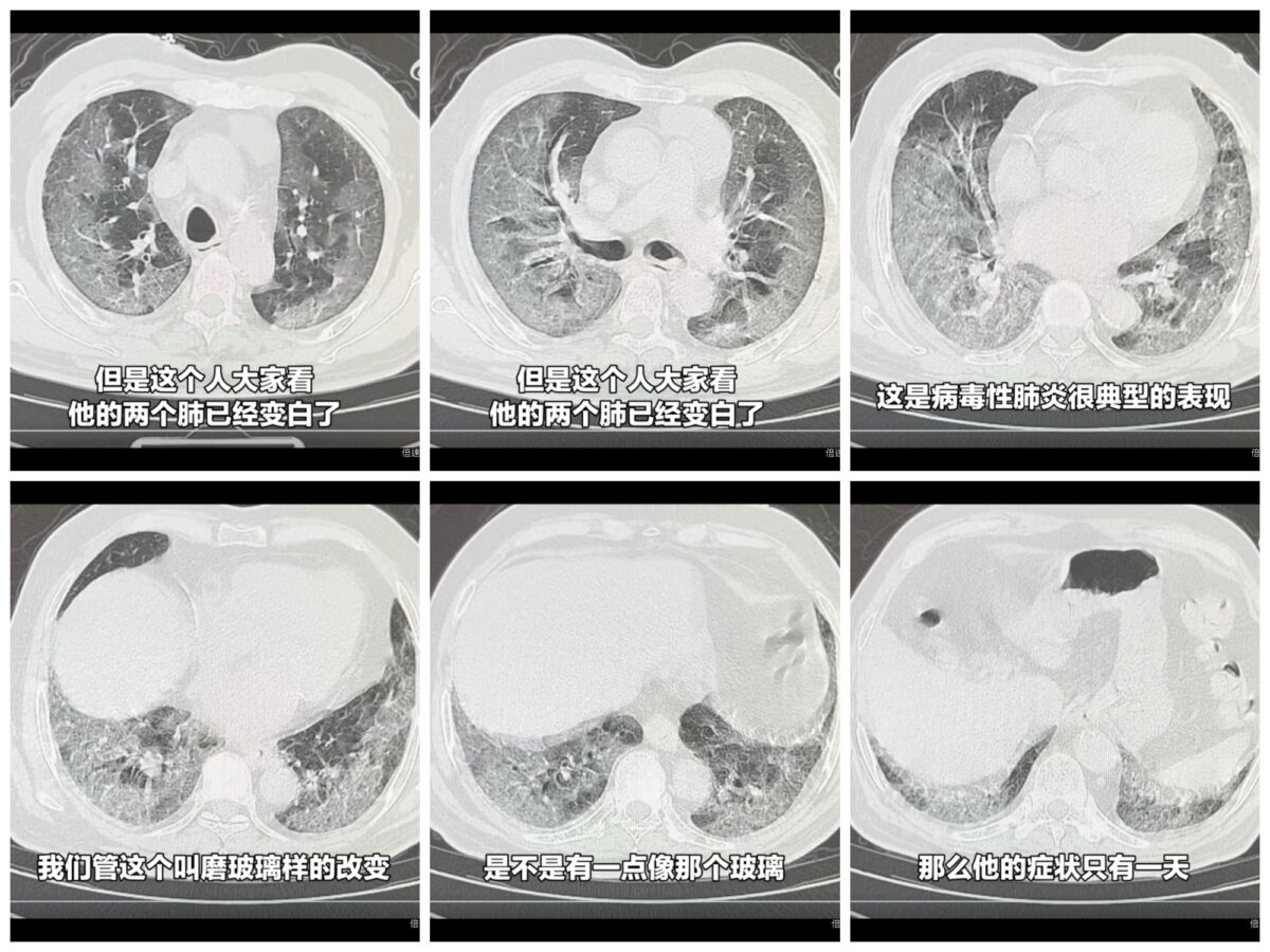 2019年原始毒株重现？网传许多患者现“白肺”　专家：中国境内监测到130多个变异株